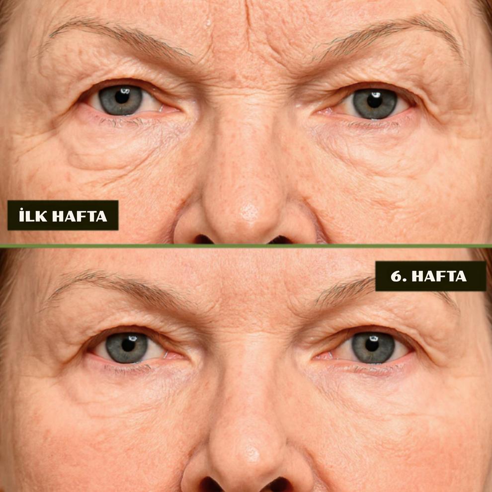 Yara İzi ve Kırışıklık Kapatıcı Silkon Bant