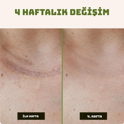 Yara İzi ve Kırışıklık Kapatıcı Silkon Bant